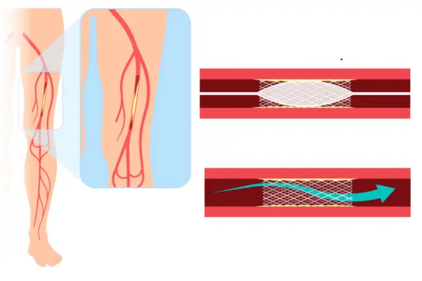 pheripheralangioplastyinmumbai