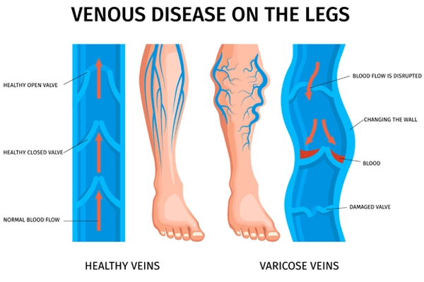 valveinlegs-varicoseveinstreatment